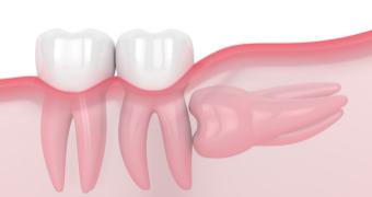 Extracción de dientes