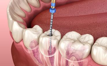 Endodoncias en Cusco